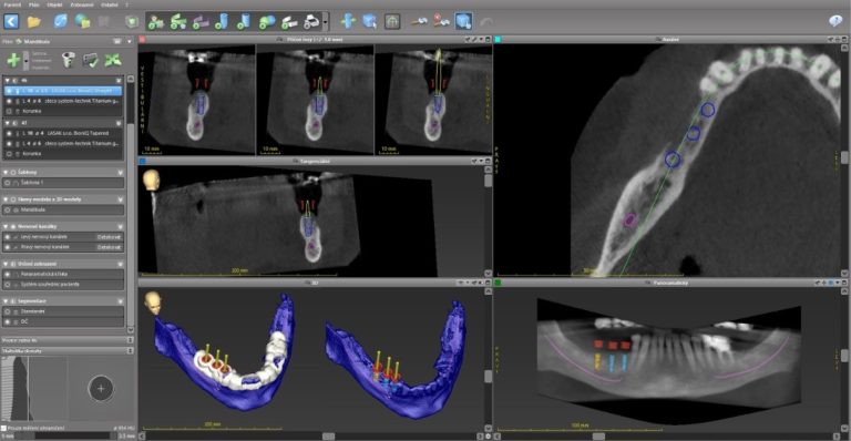 Plně navigovaná implantace se třemi implantáty BioniQ